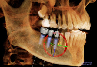 maui oral surgery wisdom teeth